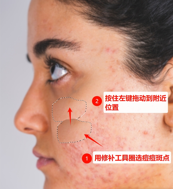 修补工具+仿制图章工具去除痘痘斑点方法