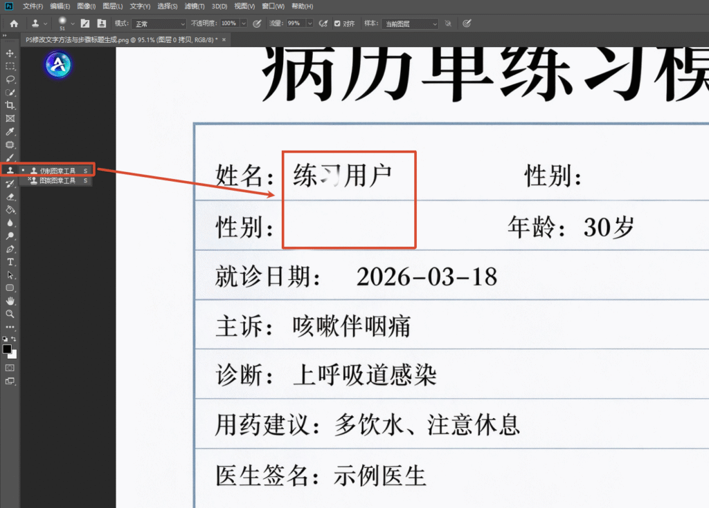 PS 软件界面截图,选用仿制图章工具,对病历单模板里 “姓名” 右侧的 “练习用户” 文字区域进行涂抹覆盖,清除原有文字,还原白色背景。